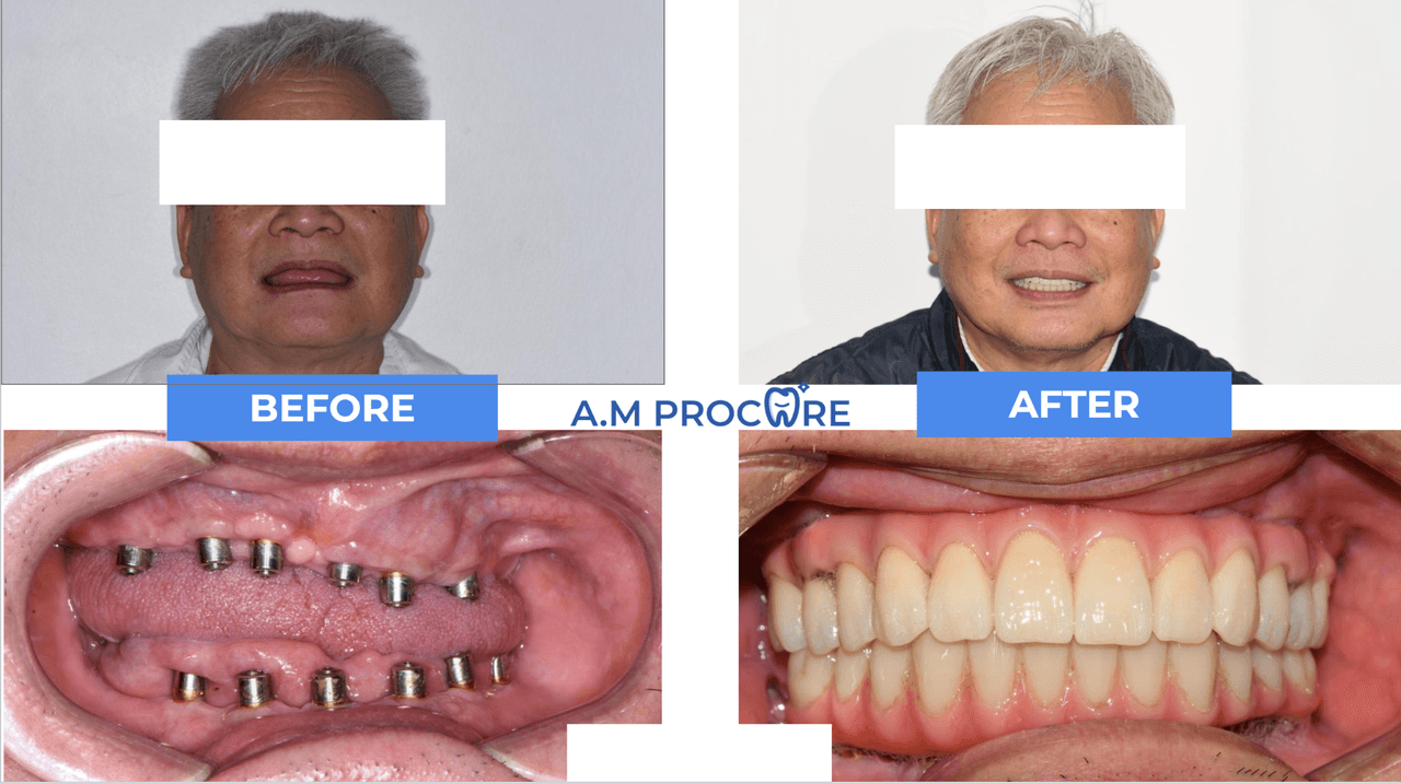 Cosmetic dentistry and veneers