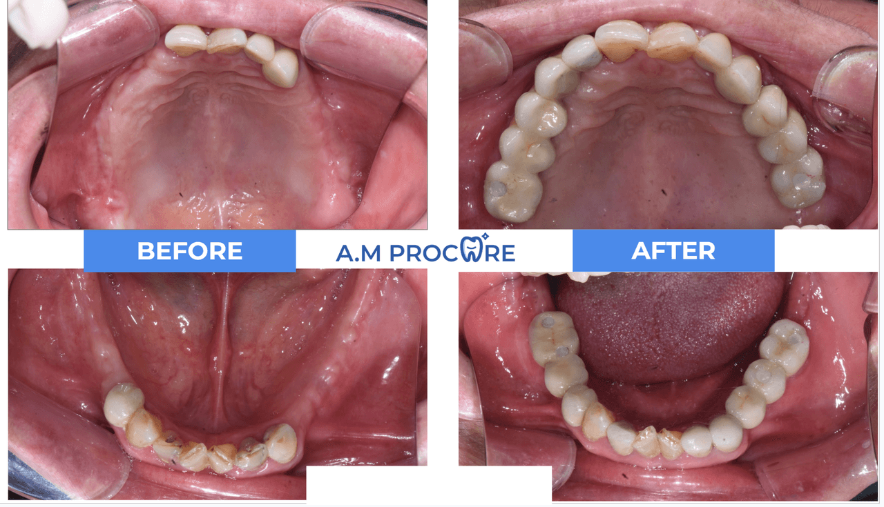 Dental before and after — shade control comparison