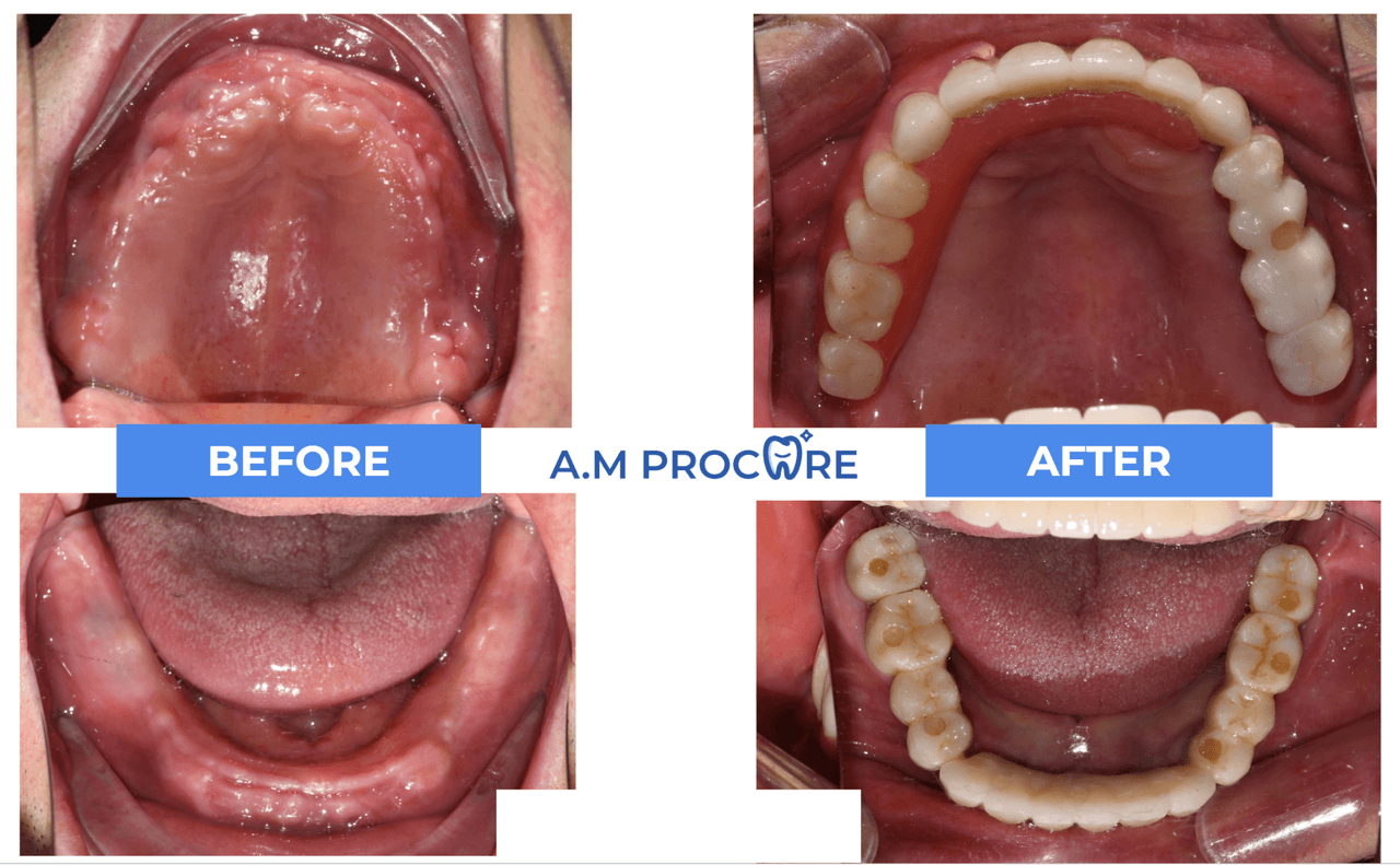 Dental before and after — diastema or spacing closure
