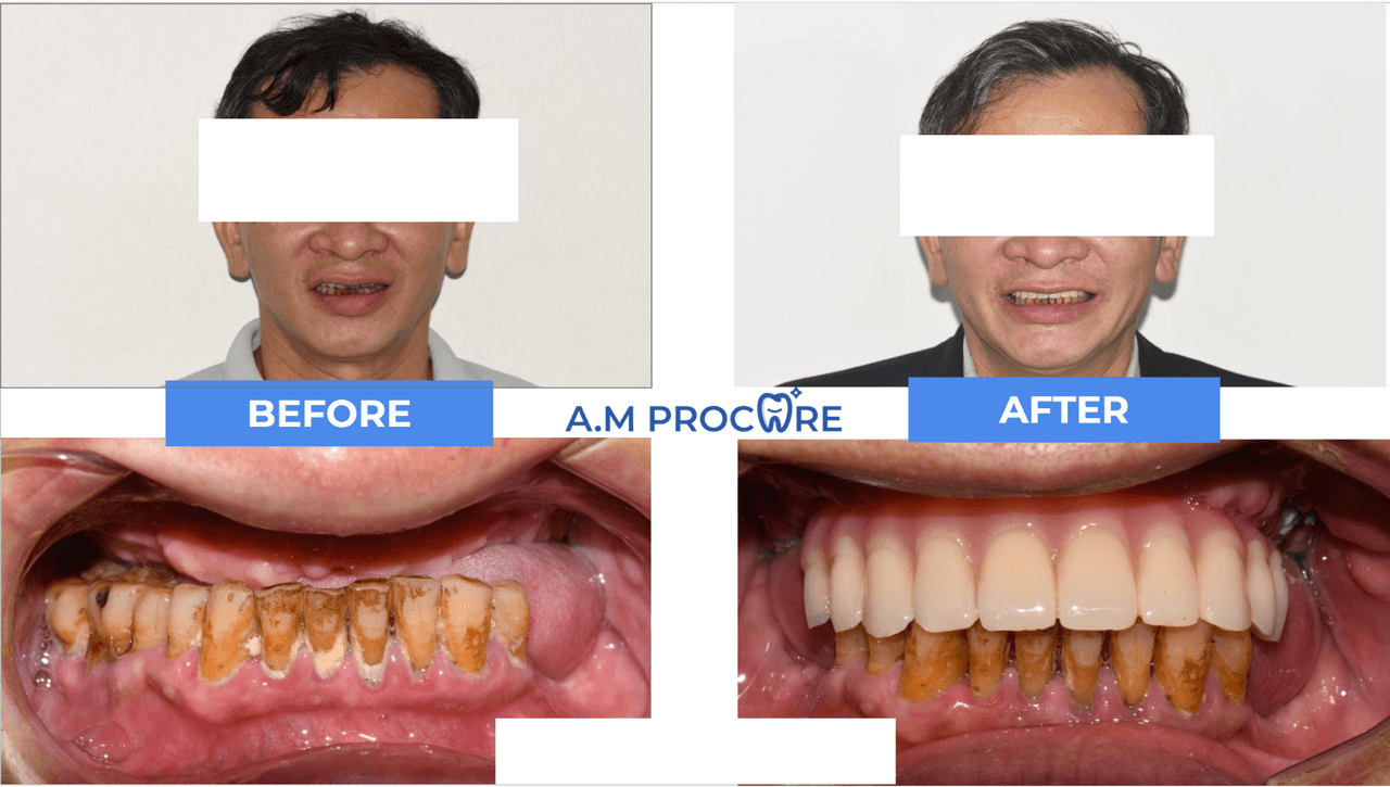 Dental before and after — worn edge restoration