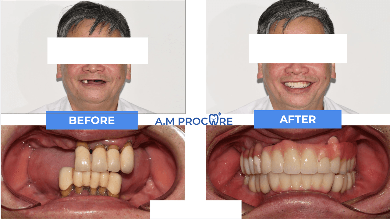 Dental before and after — multi-tooth aesthetic case