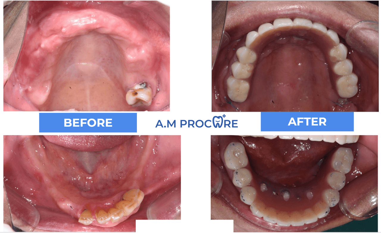 Dental before and after — smile design outcome